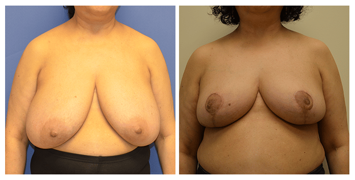 breast reduction portland or