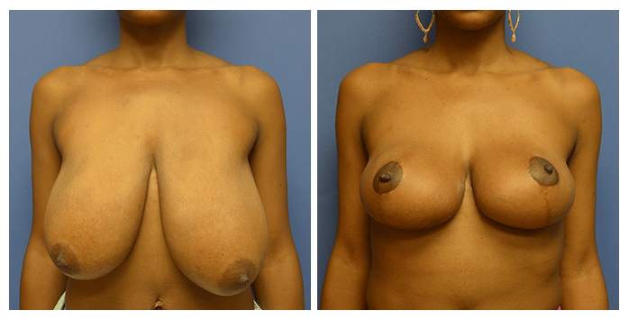 breast reduction portland or