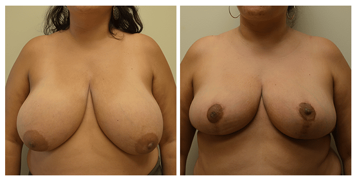 breast reduction portland or