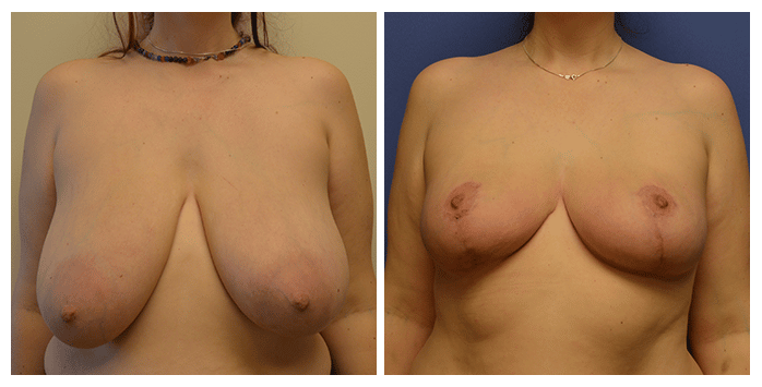 breast reduction portland or