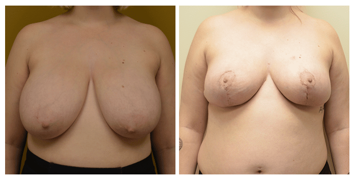 breast reduction portland or