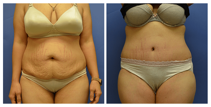 portalnd tummy tuck before and after
