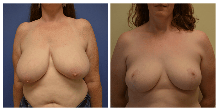 https://www.drfichadia.com/wp-content/uploads/2018/07/Fichadia_BA_Breast-Reduction_12_Front-1.png