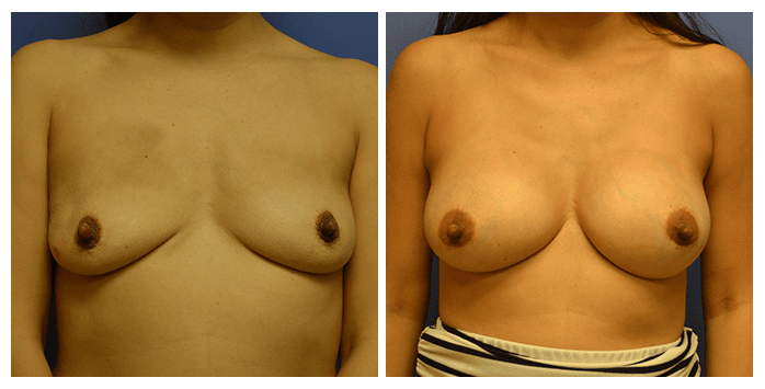 https://www.drfichadia.com/wp-content/uploads/2019/07/Fichadia_BA_Breast-Augmentation_2_AP.png