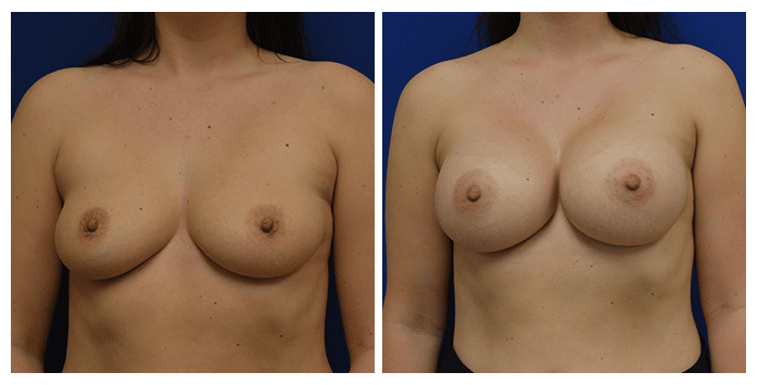 https://www.drfichadia.com/wp-content/uploads/2019/07/Fichadia_BA_Breast-Augmentation_3_AP.png