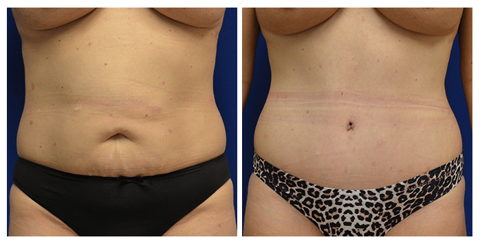 https://www.drfichadia.com/wp-content/uploads/2020/03/Fichadia_BA_Abdominoplasty_4_AP.png