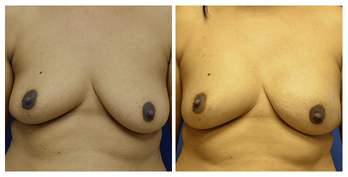 https://www.drfichadia.com/wp-content/uploads/2020/03/Fichadia_BA_Breast-Reconstruction_3_AP.png