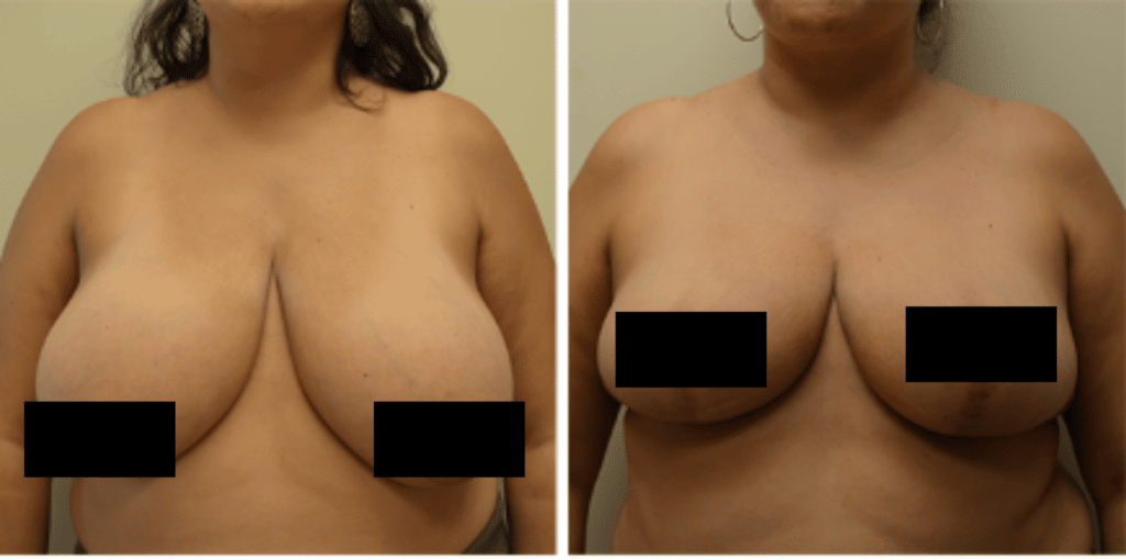 breast reduction dr. ficahdia portland