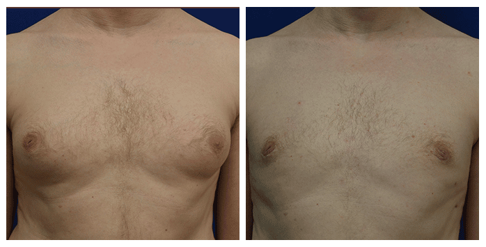 https://www.drfichadia.com/wp-content/uploads/2020/08/Fichadia-portland-BA-gynecomastia-1-1.png