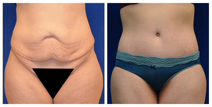 Tummy Tuck Portland, OR  Abdominoplasty Beaverton, Oregon