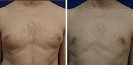 https://www.drfichadia.com/wp-content/uploads/2020/12/male-breast-reduction-man-boobs-portland-before-after-fichadia.png