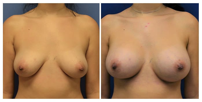 https://www.drfichadia.com/wp-content/uploads/2021/05/Fichadia_BA_BreastAugmentation_10_Front.jpg