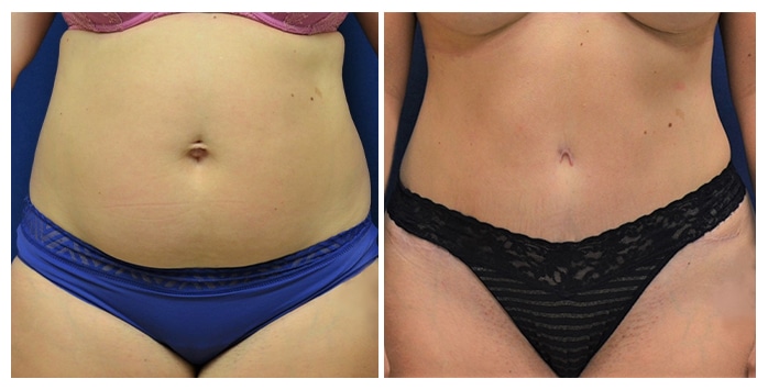 https://www.drfichadia.com/wp-content/uploads/2021/08/Fichadia_BA_Abdominoplasty_19_Front.jpg