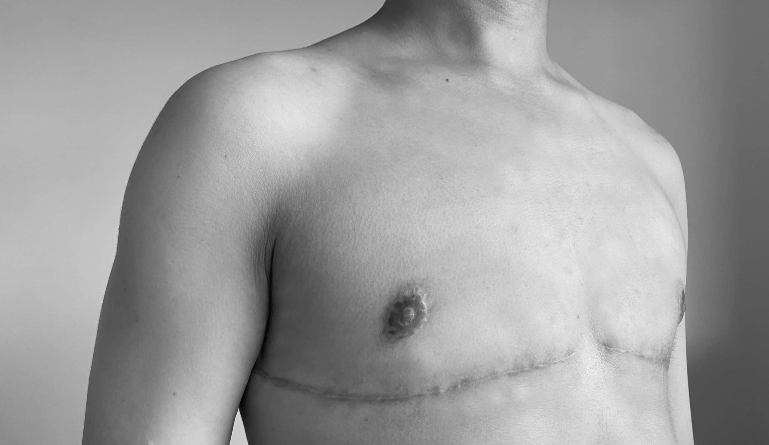 træt grinende Duplikering What Happens To Nipples After Top Surgery? - Fichadia