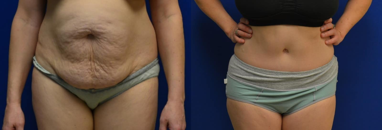 before and after tummy tuck