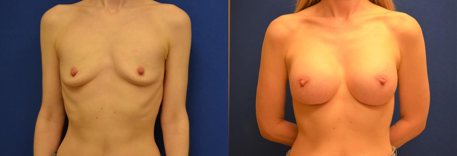 before and after breast augmentation