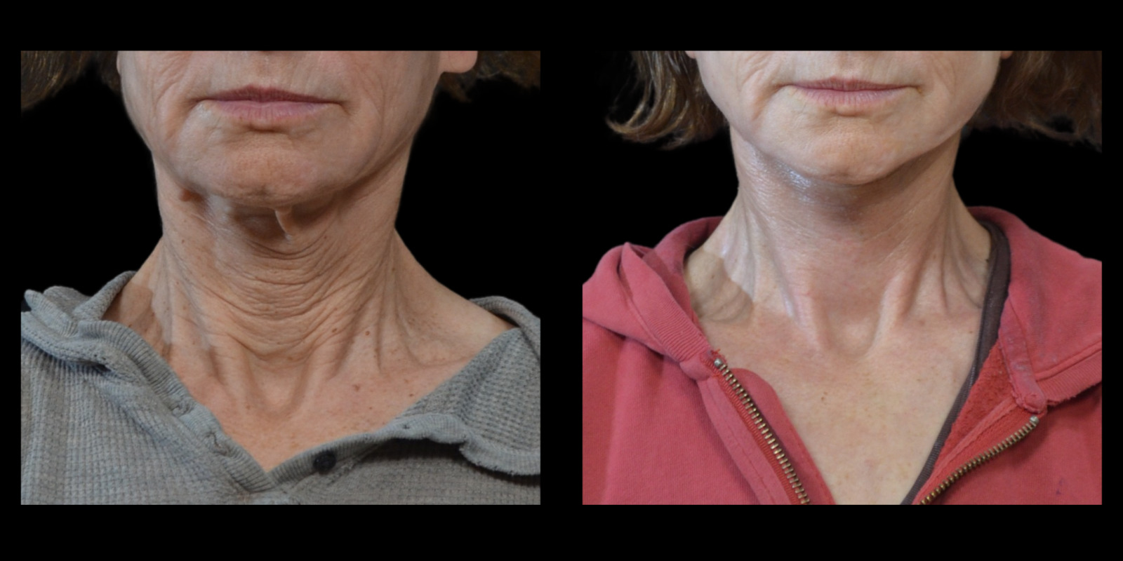 before and after neck lift